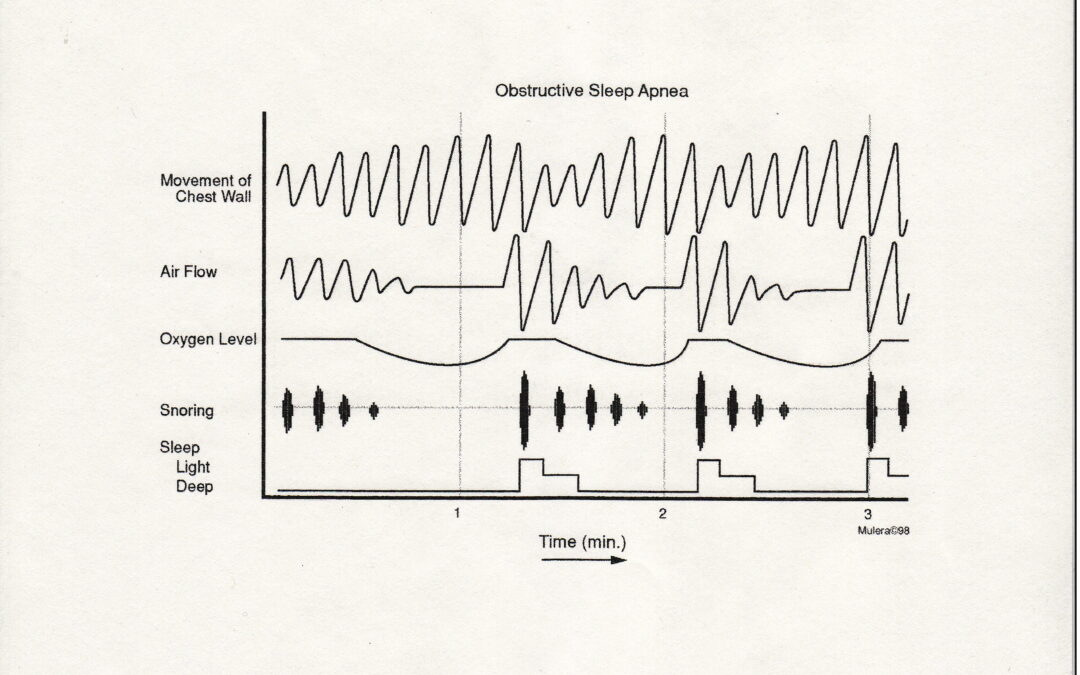 What is Obstructive Sleep Apnea