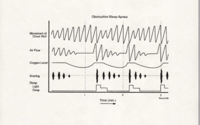 What is Obstructive Sleep Apnea